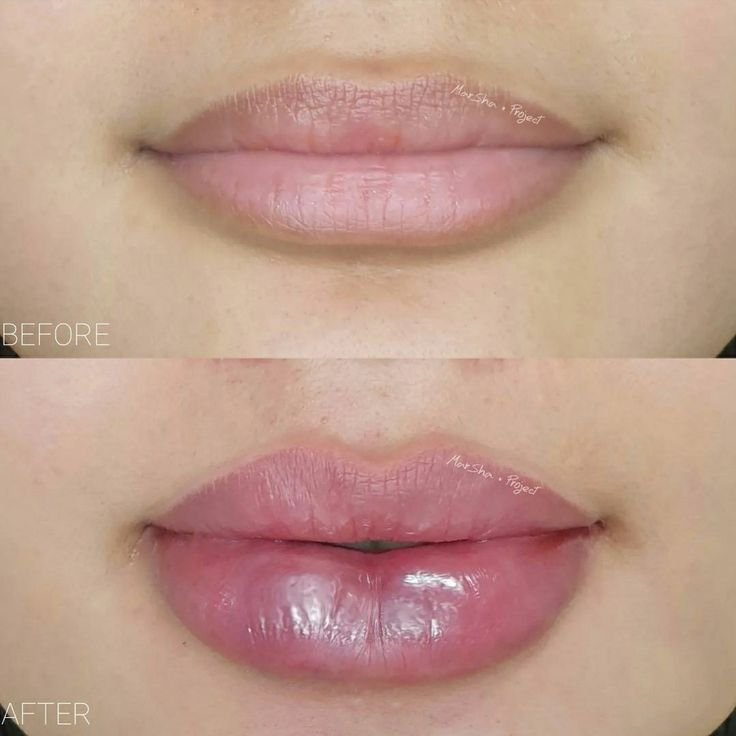 Lip Volumization
